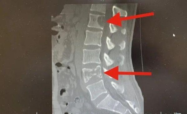 金顶配资 28岁奶爸腰痛半年，一查竟是肺癌晚期，开始没在意，以为是抱孩子累的